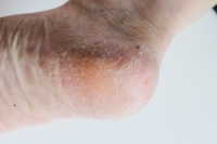 What Causes Cracked Heels?