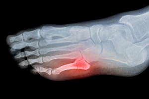 Causes and Treatment of Foot Fractures